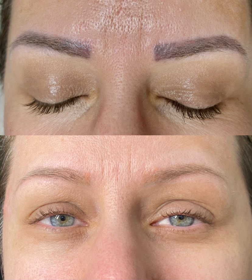 Antes e depois de remoção de sobrancelhas a laser