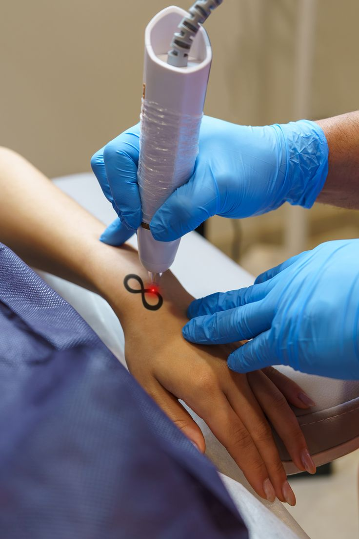 Remoção de tatuagens a laser